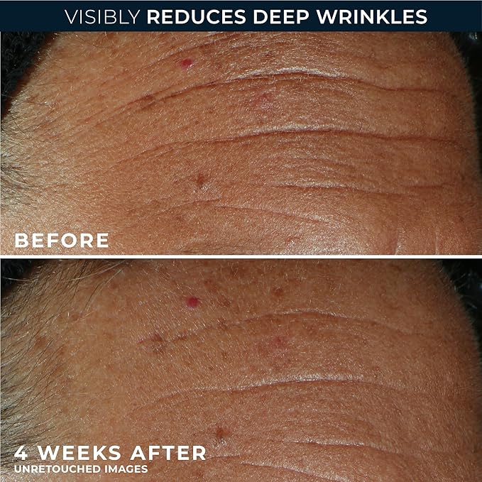 RoC Derm Correxion Fill + Treat Advanced Retinol Serum, Wrinkle Filler Treatment with Hyaluronic Acid for Crow's Feet, 11 Wrinkles, & Laugh Lines, (.5 fl oz) with Retinol Packette (Packaging May Vary)