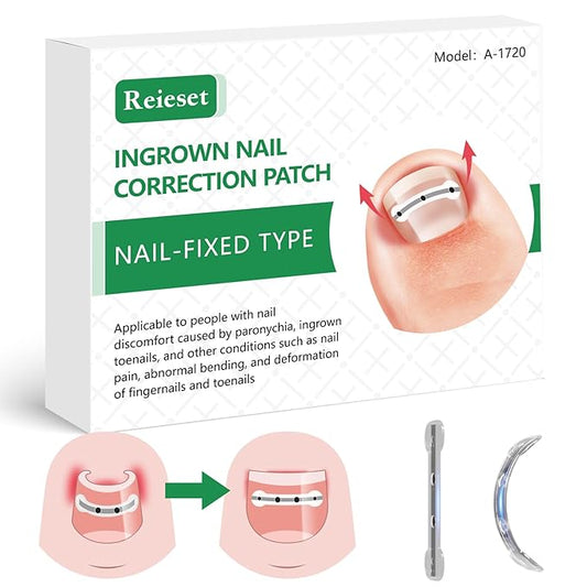 Titanium alloy ingrown toenail treatment