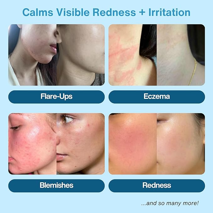 Hypochlorous Acid Spray – HOCl Face & Body Mist for Acne, Eczema & Irritation – Multi-Purpose Skin Repair – Eyelid Cleanser, Post-Workout/Procedure, Scalp & Sensitive Skin (2 oz+6.8 oz)