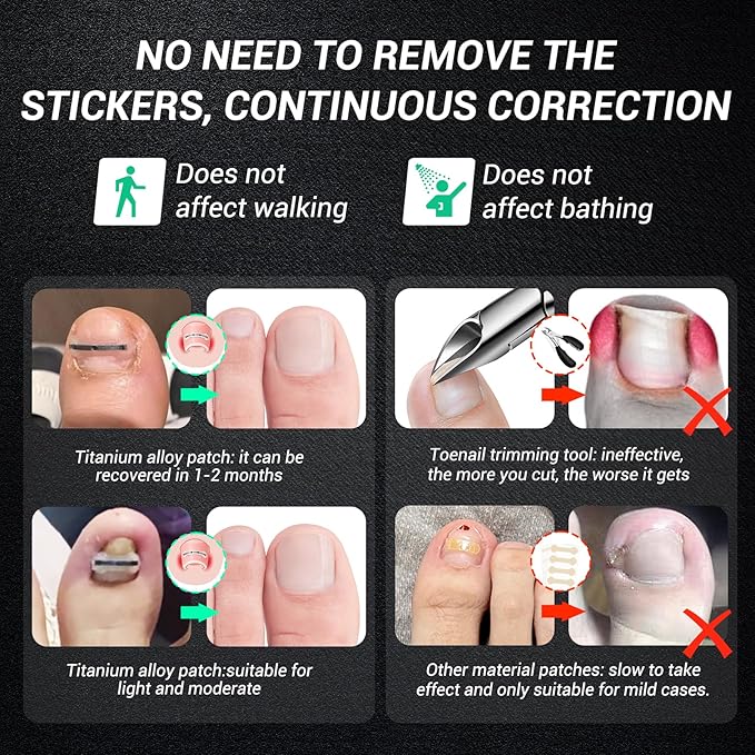 Titanium alloy ingrown toenail treatment